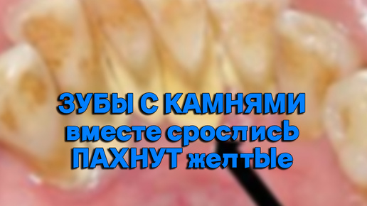 КАМНЕМ зубы СРОСЛИСЬ уже. Чистка зубов от ОГРОМНОГО камня. Ты такое не видел