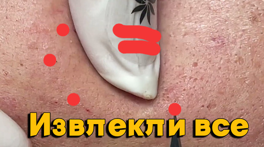 выскарябываем все грязные ЧЕРНЫЕ угри