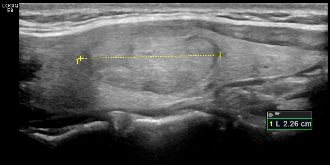 Рис. 2 Изоэхогенный узел, продольное изображение доли щитовидной железы.