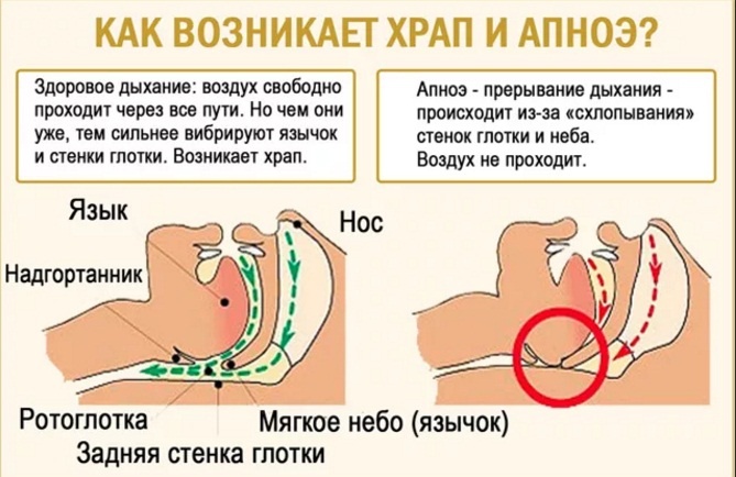 Принцип возникновения храпа и апноэ. Фото из интернета 