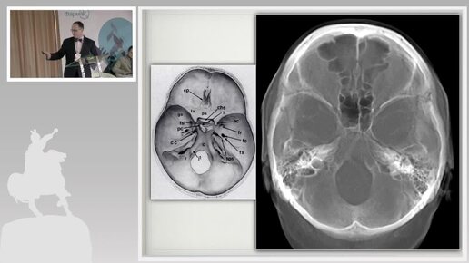 Патология основания черепа