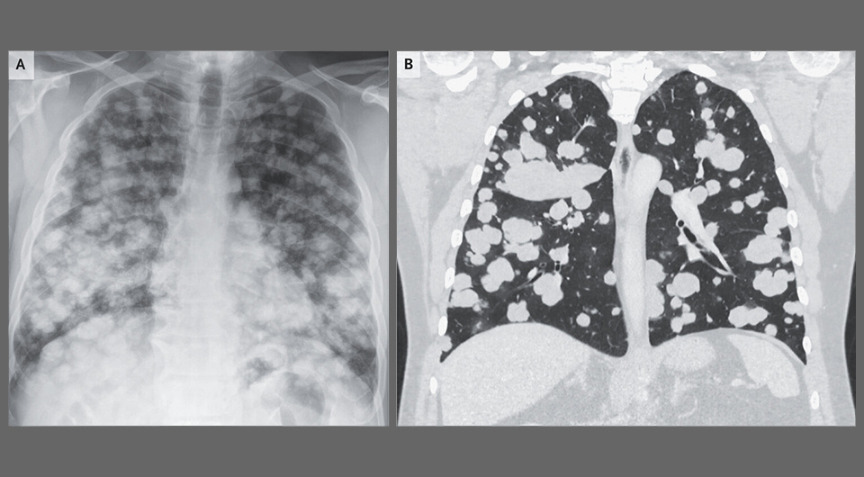   Elizabeth Wittrock, Miles D. Hagner / NEJM, 2024