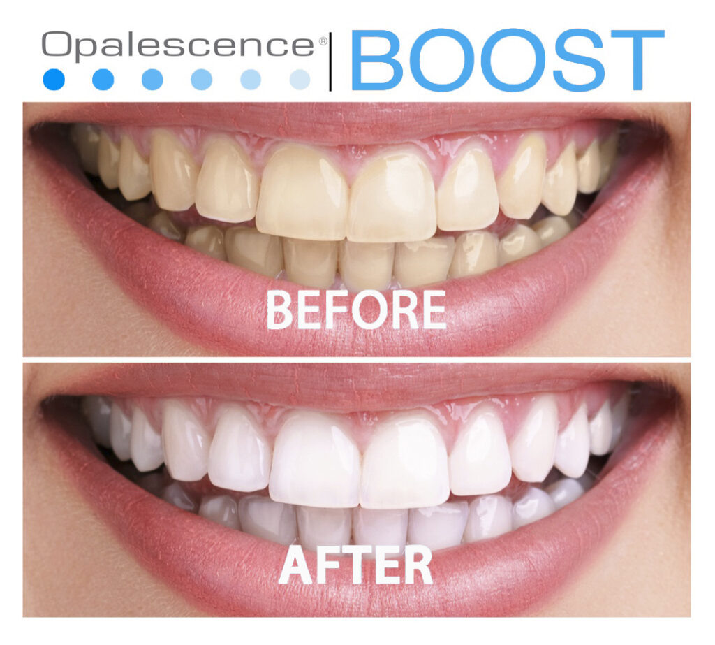 До/После. Отбеливание профессиональной системой - Opalescence.