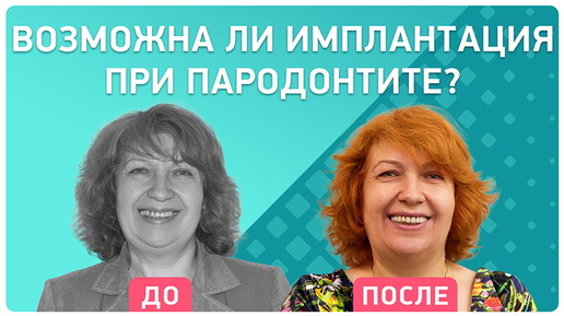 Комплексная имплантация на фоне пародонтита – отзыв пациентки о восстановлении зубов за 3 дня