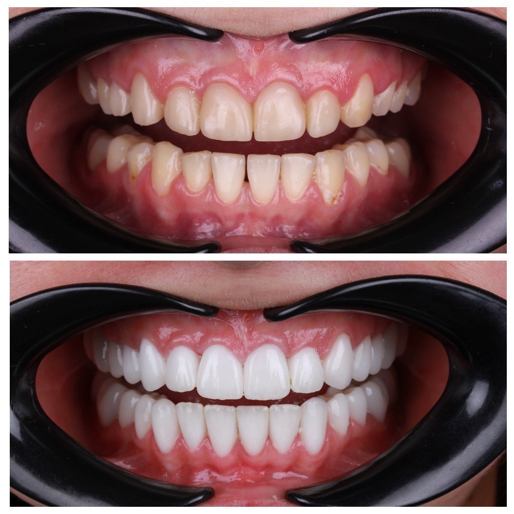 Эта работа по восстановлению эстетики была проведена специалистом клиники «Два Дантиста» стоматологом-ортопедом Лукьяненко Артуром Викторовичем. Была сделана реконструкция винирами, благодаря которым, форма, цвет, и рельеф приобрели гармоничный и натуральный вид.   