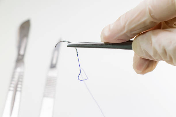 Снятие послеоперационных швов на дому