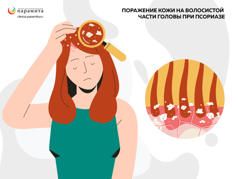 Поражение кожи на волосистой части головы при псориазе