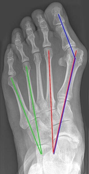    Hallux valgus Фото: Jmarchn. Собственная работа, по лицензии CC BY-SA 3.0