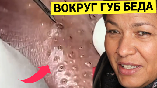 Download Video: Черные Точки в ГУБАХ выдавливаются Косметологом аккуратно. Неожиданно много Жировиков в Деликатной зоне. Требует мастерства