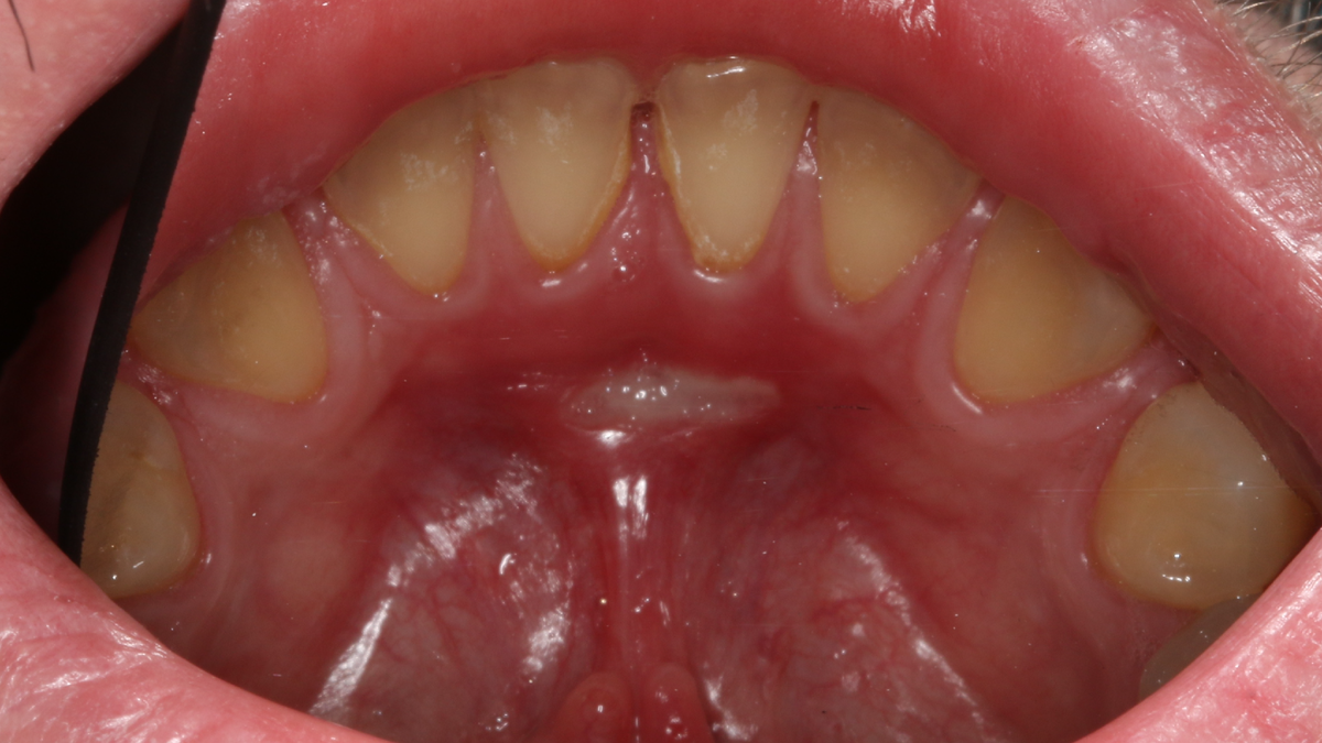 Травма уздечки языка чипсами. Заболело через 3 дня. В центре фотографии – типичная афта.