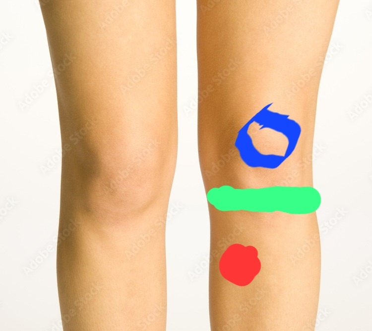 на картинке отмечены синим колёсная чашка, зелёным-составная щель, красным- болезненная зона, га которую жалуется пациентка.