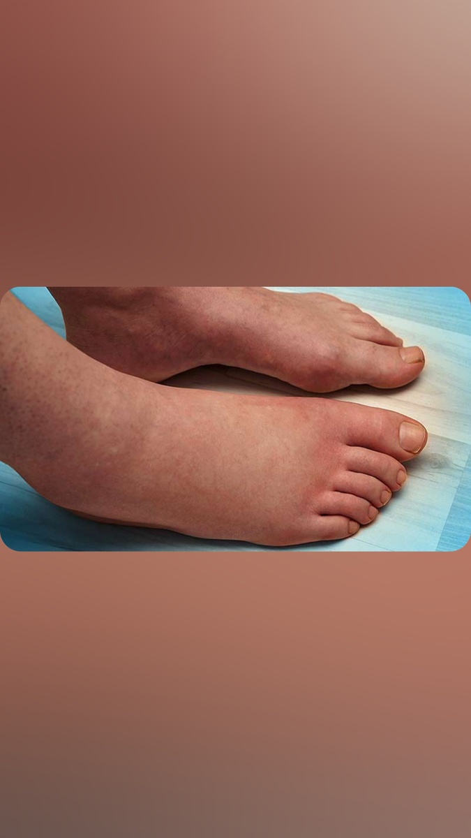 отёк стопы на той же нижней конечности, что и боль в области коленного сустава