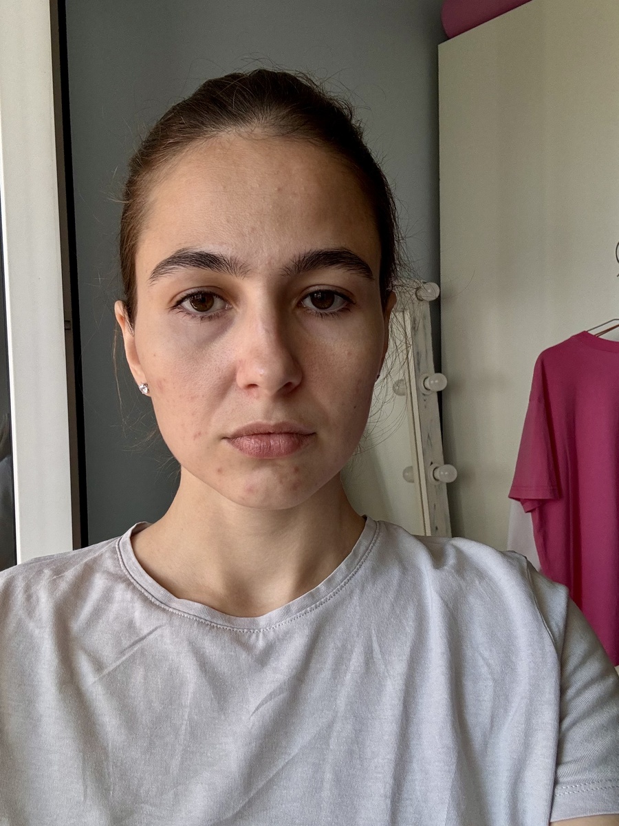 Лицо поплыло вниз. Не зря говорят, что эмоции отпечатываются на лице. Но я не ноющий человек. В большей мере все эти носогубные впадины и мешки под глазами появились из-за недосыпов и вернувшихся сладостей. Также, на нижней половине лица вновь появились высыпания.