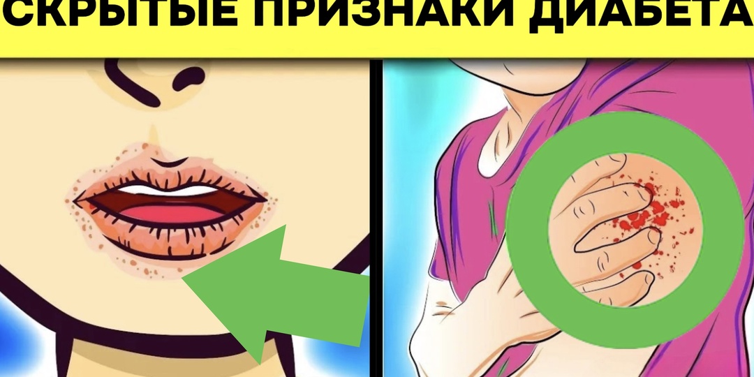 12 скрытых признаков диабета, которые не следует игнорировать (научная подборка)