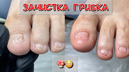 Зачистка грибка / Cleaning nail fungus