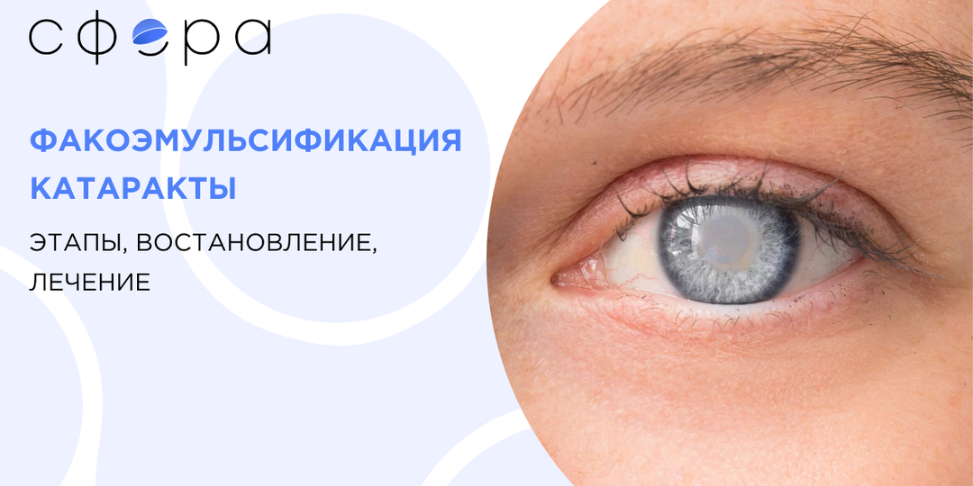 Факоэмульсификация катаракты - этапы, восстановление, лечение