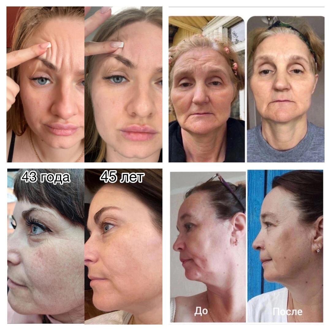 👉Много вопросов про наш коллаген. 👌Самые часто задаваемые вопросы и ответы на них ⤵ ⠀ ❓Что дает прием коллагена? ➡Одно из самых действенных средств, способных предотвращать старение организма❗ ✔️Польза для всего тела, суставов, волос, кожи, вырабатывает эластин, помогает в борьбе с морщинами и старением, способствует сохранению мышечного каркаса лица и похудению. 🧱В виде бада дает необходимые нам "кирпичики" для производства собственного коллагена. ⠀❓В чем разводить коллаген? ➡Вода. ⠀ ❓ Правда, что с витамином С коллаген более эффективен? ➡Да, витамин С усиливает эффект. Достаточно принимать суточную норму витамин С (60 мг). 👌Коллаген от NL уже содержит вит С. ⠀ ❓ Чем коллаген в порошке лучше, чем в таблетках? ➡Коллаген в порошке быстрее усваивается организмом, чем таблетка, которая растворяется в системе пищеварения около 30 минут❓ Какой курс коллагена? ➡Оптимальный курс приема - 3 месяца. 2 месяца - перерыв. ⠀ ❓ Полнеют ли от коллагена? ➡Нет. Причина лишнего веса - избыток калорий . Порция коллагена в порошке - это 22 ккал. Коллаген - это белок. 😱У вас ещё нет COLLAGEN peptides?! Тогда я иду к вам😂 🔝Это коллаген расщепленный до пептидов с высоким содержанием аминокислот, двумя активными формами витамина С, обогащенный прокератиновым комплексом.📝для заказа пиши в ЛС