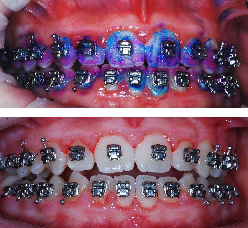 На верхней картинке специальный индикатор для определения налета