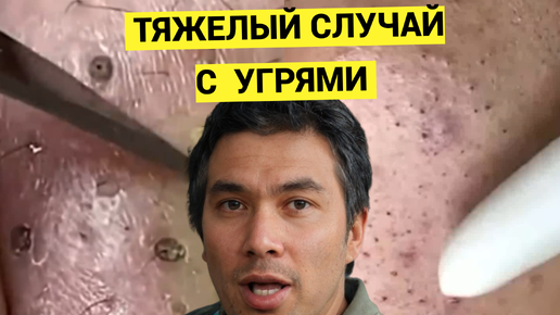 Угри и Жировики с Комедонами оказались Не подарок для Косметолога. Применил все инструменты, что были, но все равно не справился