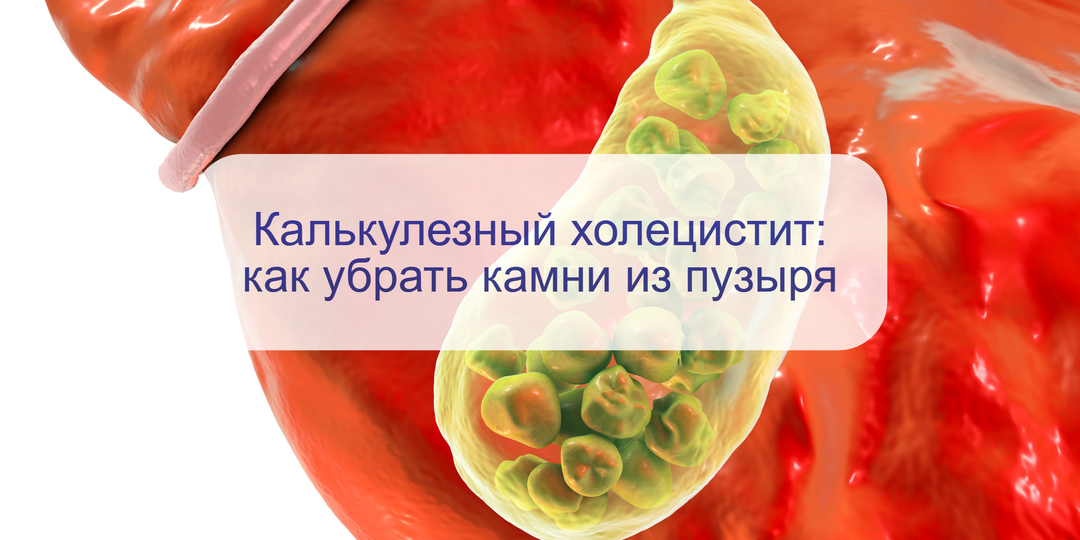 Камни в желчном пузыре: врач назвала 6 признаков острого холецистита – что делать