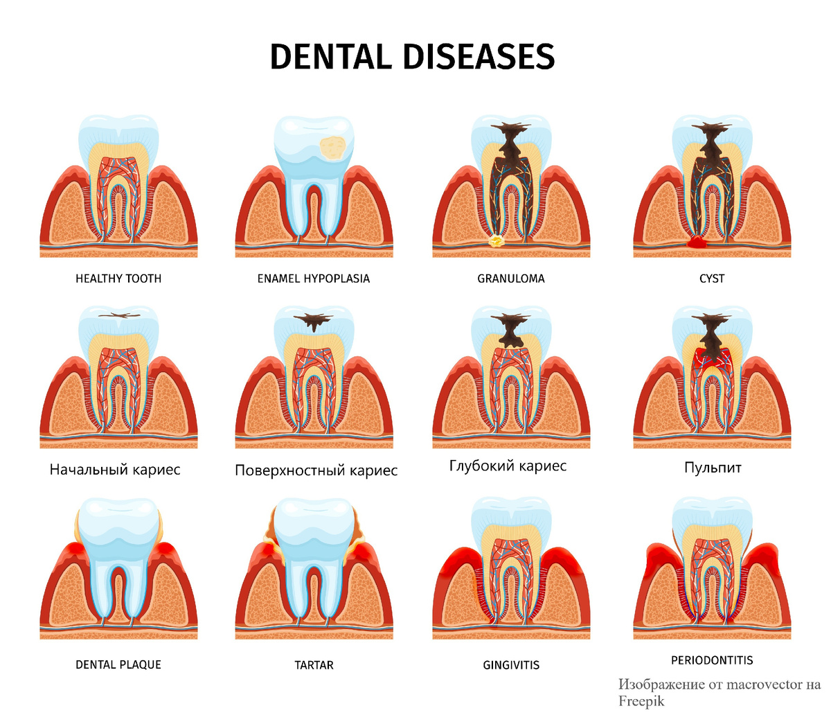 Нас интересует средний ряд, на котором показан весь процесс - от появления кариеса в виде пятна до воспаления нерва. www.freepik.com