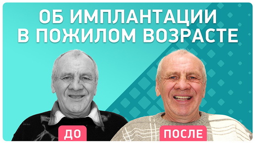 Отзыв пациента о протезировании всех зубов на четырех имплантах