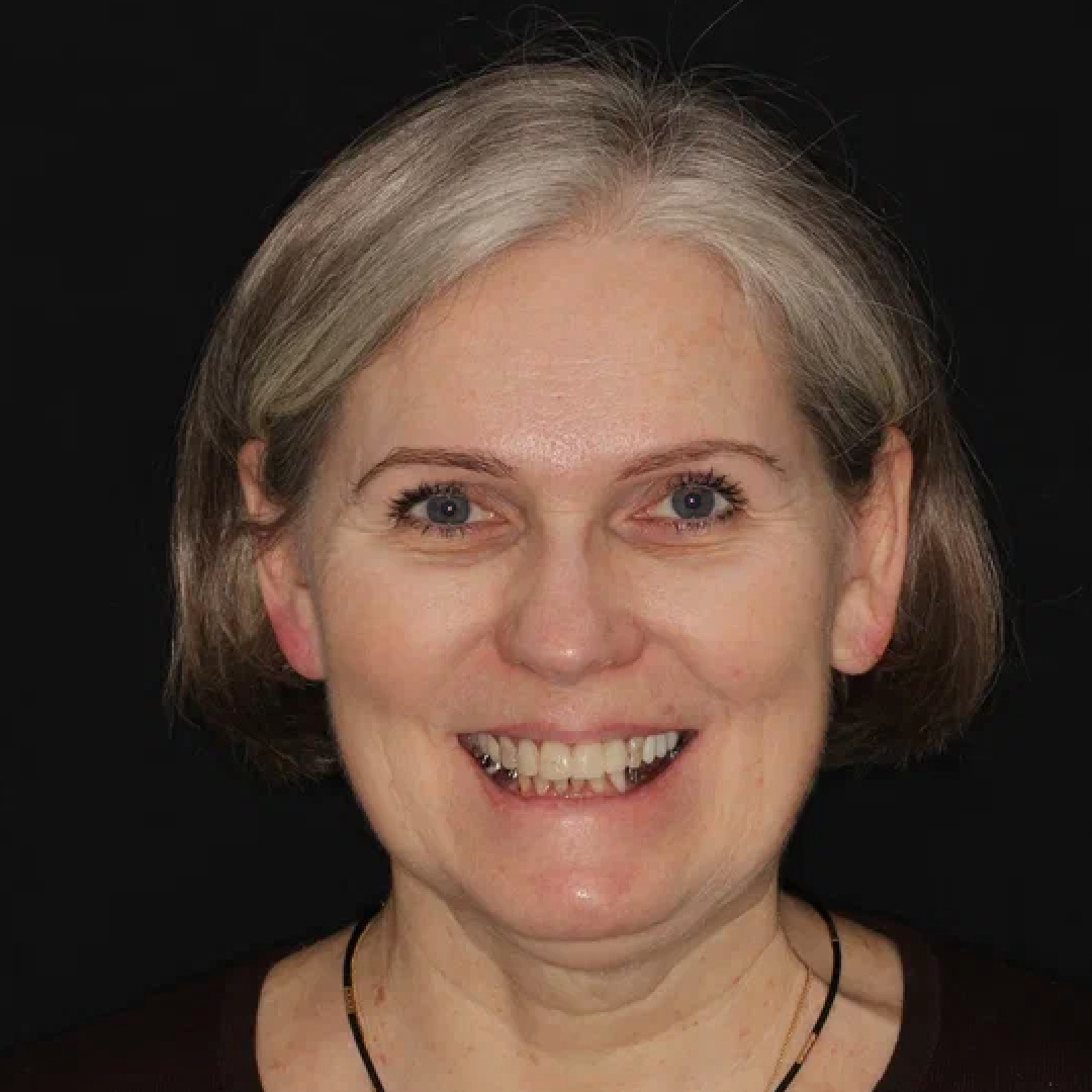 Пациентка до и после лечения