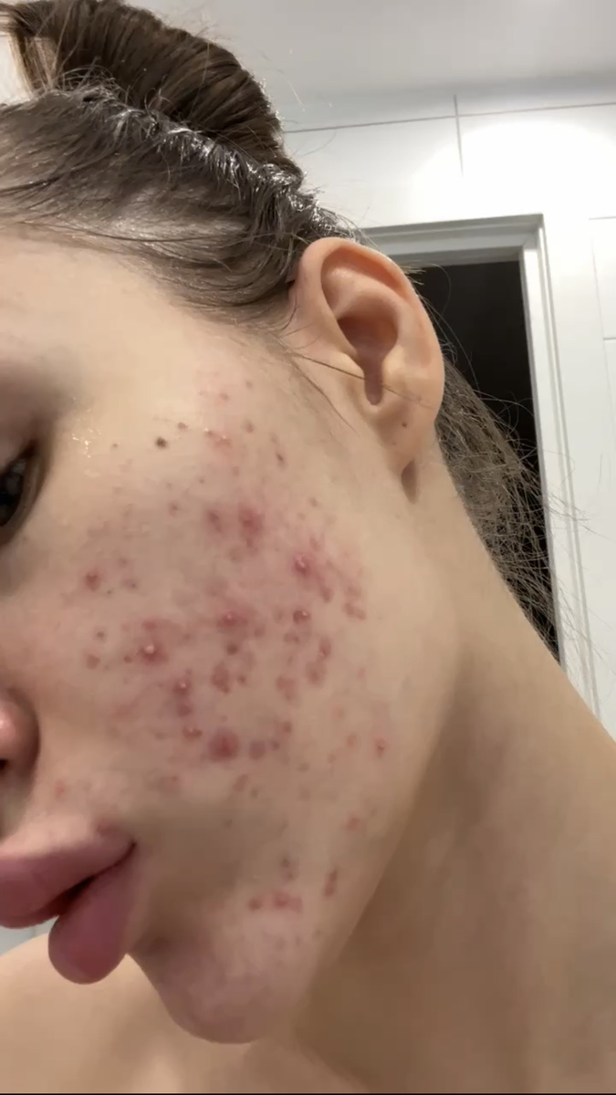 здесь можно увидеть большое количество воспалений, которых с каждым днем становилось больше, постепенно переходя на шею.