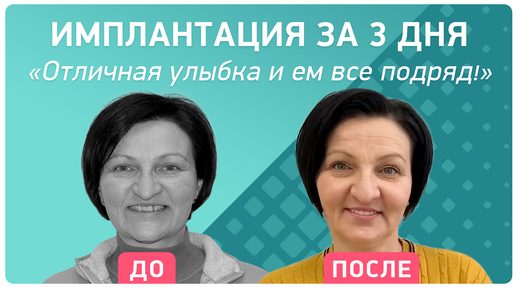 Комплексная имплантация всех зубов – ощущения пациента и этапы лечения