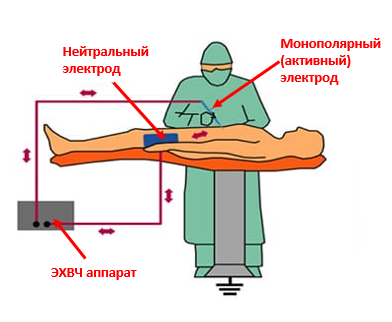 Путь тока и расположение электродов при монополярной электрохирургии