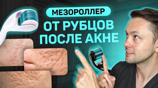 Средство от рубцов. Мезороллер. Советы от врача косметолога