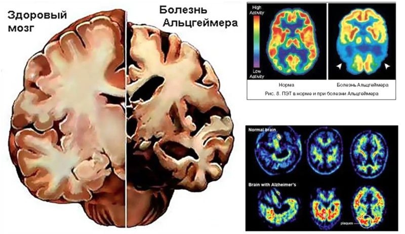 МРТ головного мозга здорового человека и пациента с БА; ПЭТ здорового и больного с БА.