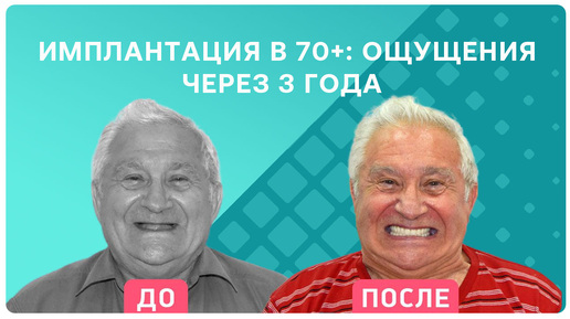 Комплексная имплантация зубов в 70+ с немедленным протезированием: отзыв через 3 года