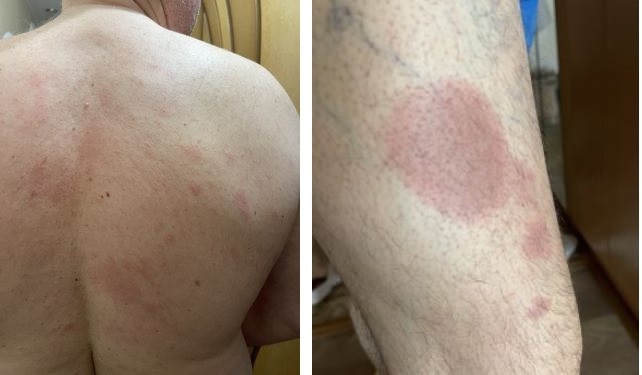 Развитие аллергии