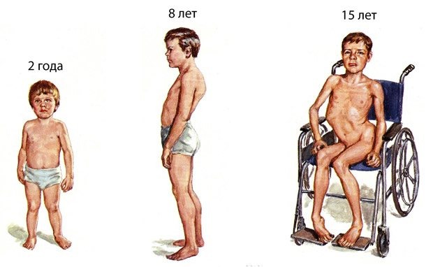 Спойлер: до 30 он не доживет