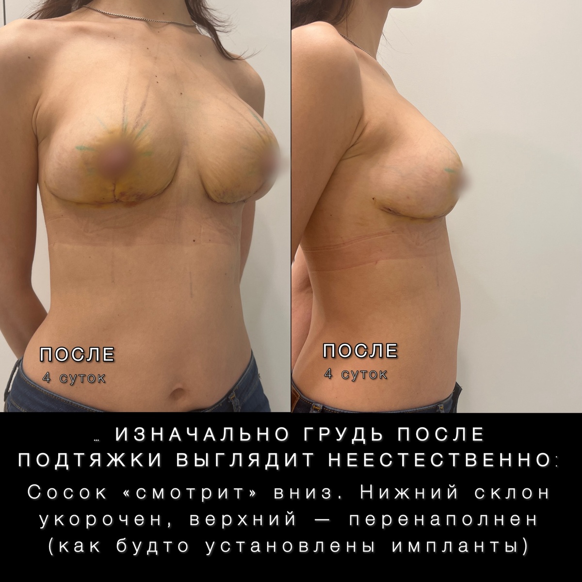 4-ро суток после подтяжки молочных желёз