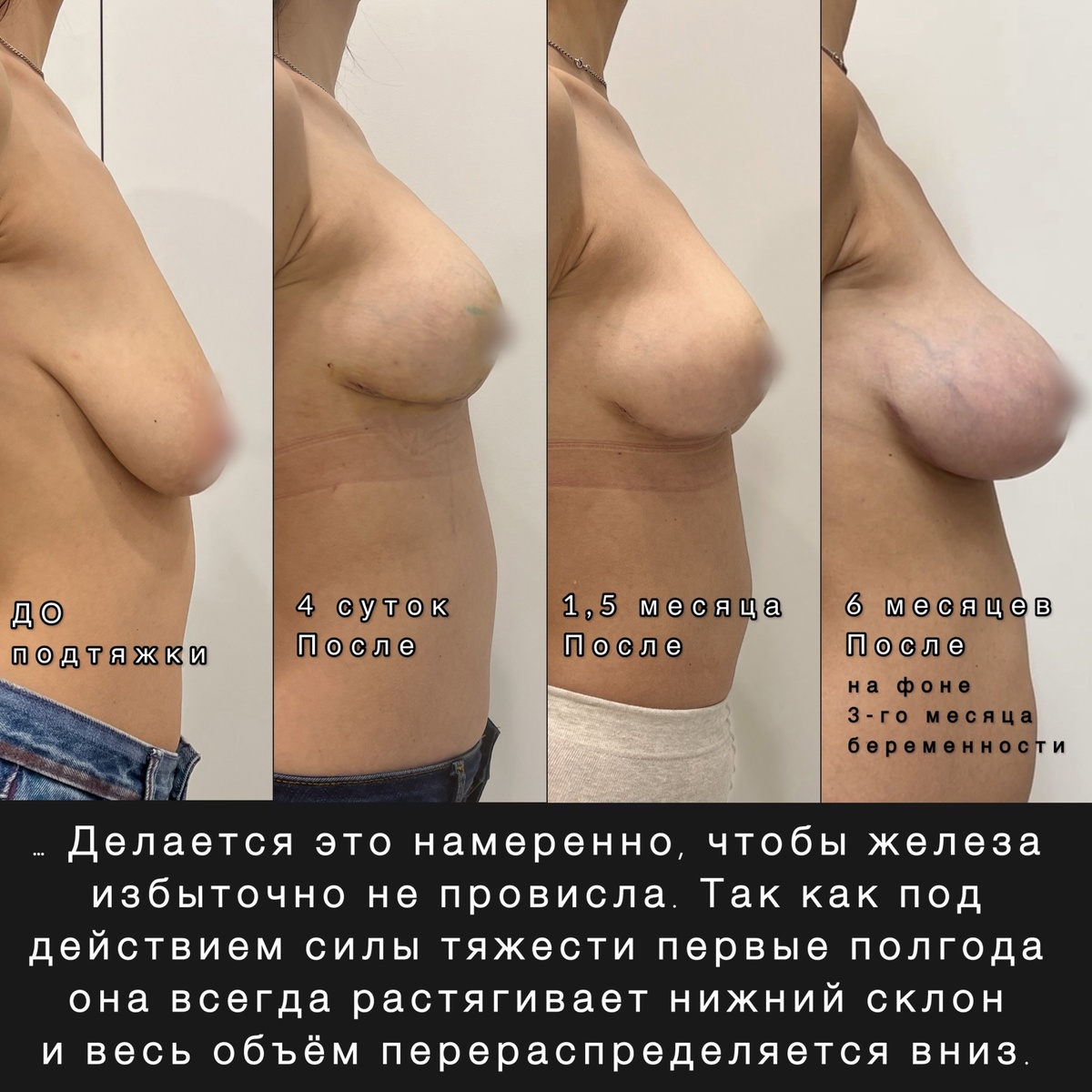 Нижний склон железы при подтяжке укорочен намеренно