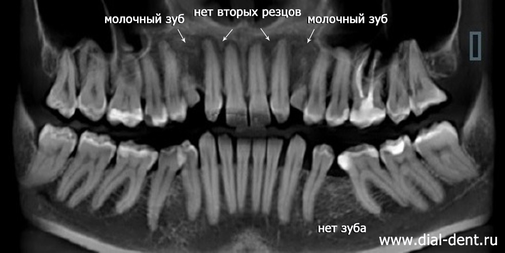 панорамный снимок зубов до лечения