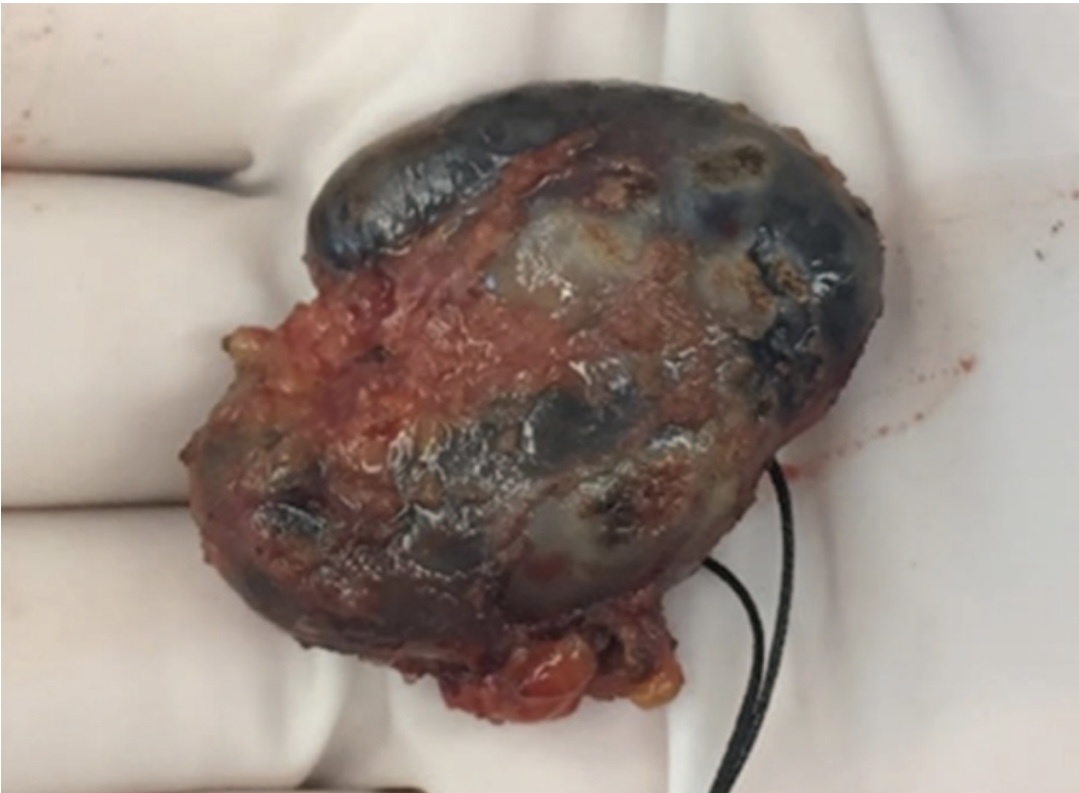 Пострадавший лимфоузел