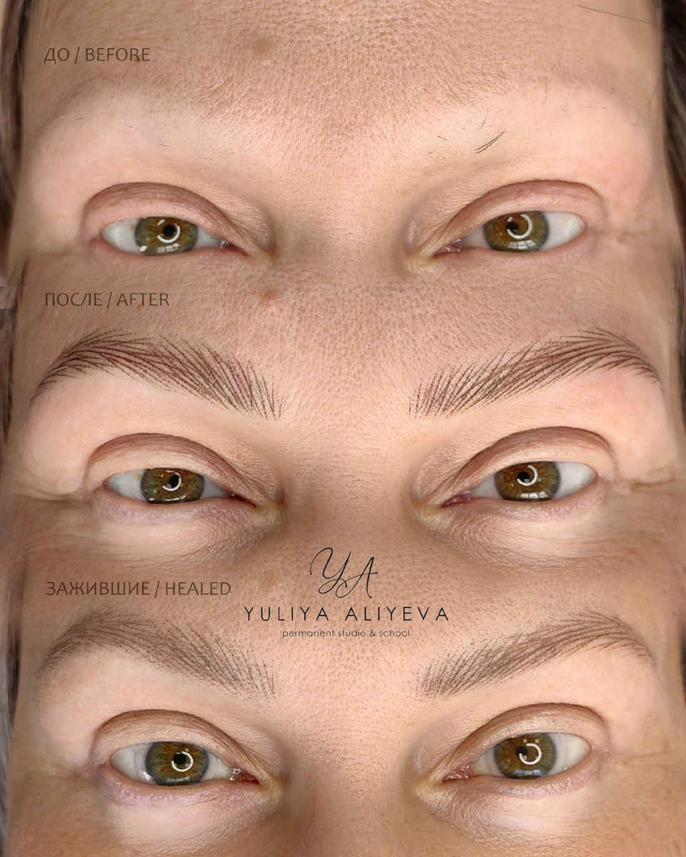На фото - перманентный макияж бровей в технике Realistic Hairs при алопеции: до, результат сразу после процедуры и заживший результат после 1 процедуры спустя 1 месяц