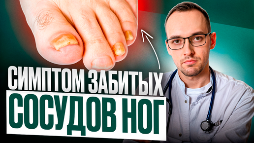 Tải video: 5 ПРИЗНАКОВ ЗАБИТЫХ СОСУДОВ НОГ. Как проверить дома без врача?