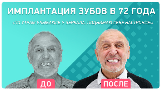 Имплантация зубов в 70 лет – отзыв пациента через 1 год после операции