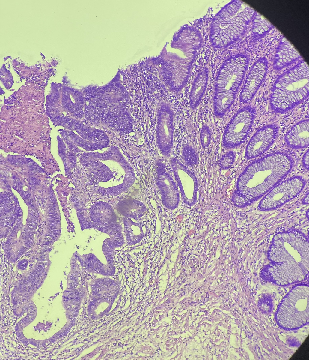 Биоптат кишки, тут есть рак