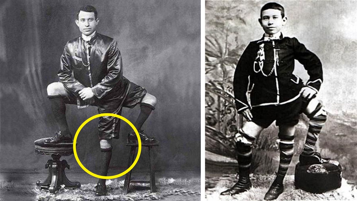 Франческо Лентини - человек, родившийся с тремя ногами.