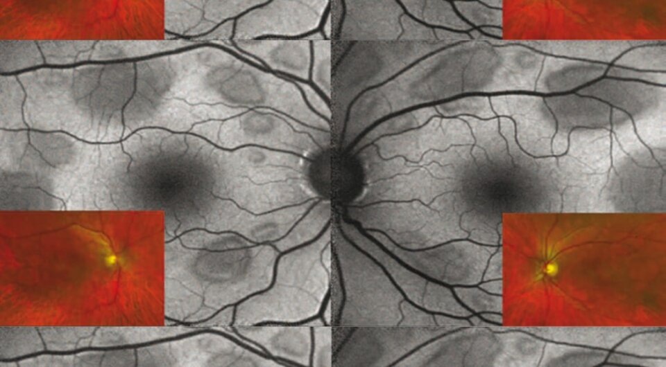   Nicolas Chirpaz et al. / JAMA Ophthalmology, 2024