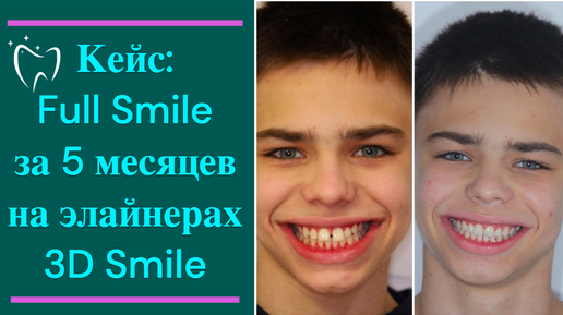 Download Video: 💎 Кейс: исправление прикуса на элайнерах 3D Smile за 5 месяцев