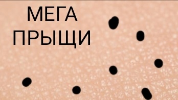 Выдавливание сочных мега прыщей и угрей. Почему их так много