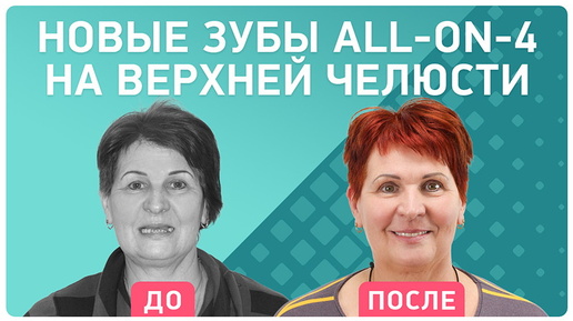 All-on-4 на верхней челюсти: импланты и протез сразу – отзыв пациента