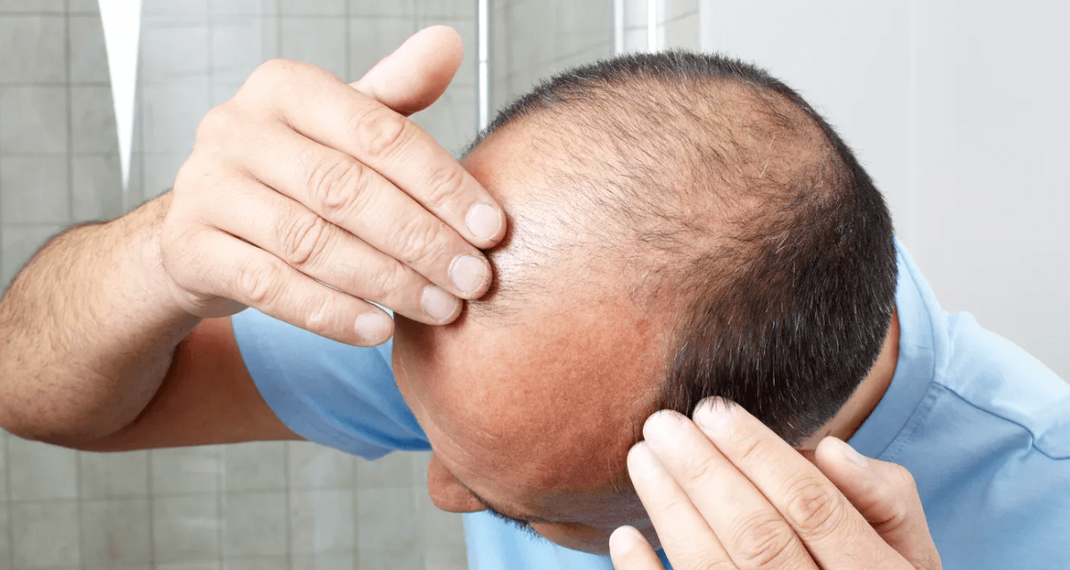    У мужчин лысина возникает на макушке, при этом на затылке и по бокам волосы остаются. Источник фото: ria.ru