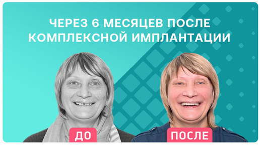 Через 6 месяцев после имплантации верхней челюсти за 3 дня 👉 отзыв пациента